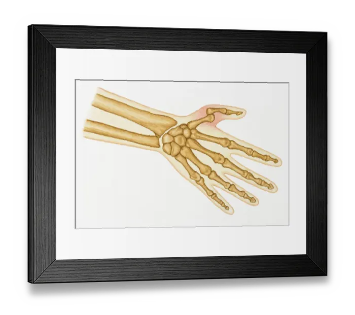 Framed Print : Illustration of bones in human hand and dislocated thumb Framed Print : Illustration of bones in human hand and dislocated thumb