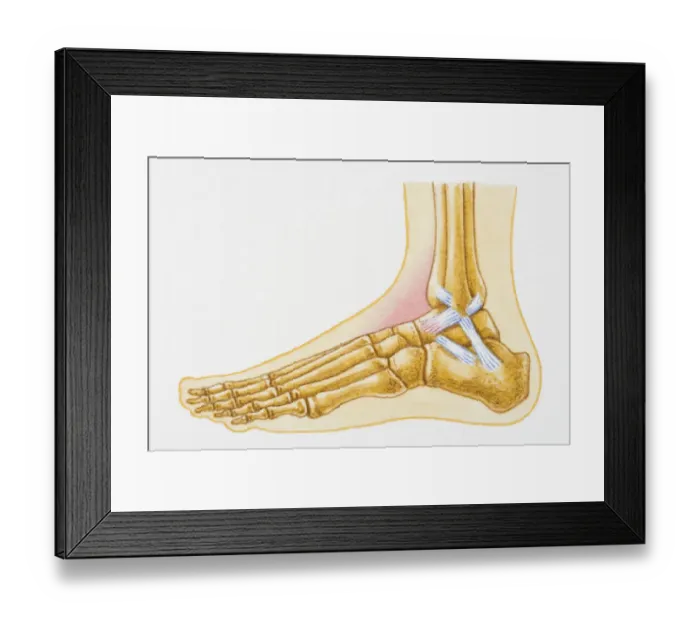 Framed Print : Illustration showing swollen talocrural joint caused by sprain to anterior talofibular ligament