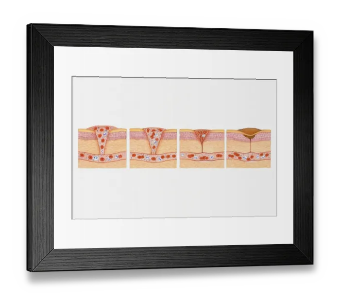 Framed Print : Illustration of formation of blood clot in series of four cross section illustrations showing blood oozing from blood vessel through wound before forming platelet plug Framed Print : Illustration of formation of blood clot in series of four cross section illustrations showing blood oozing from blood vessel through wound before forming platelet plug