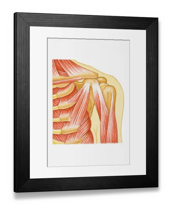 Framed Print : Illustration of separated shoulder, also known as a sprain, with circle around glenohumeral ligament Framed Print : Illustration of separated shoulder, also known as a sprain, with circle around glenohumeral ligament