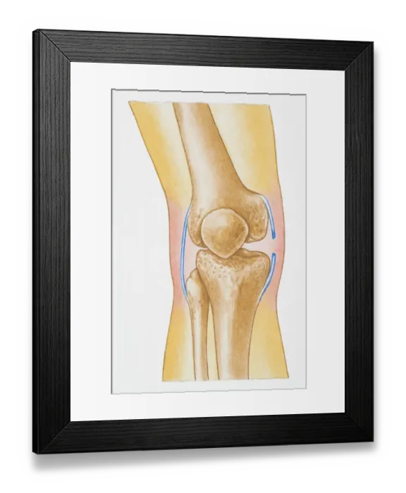 Framed Print : Illustration showing torn human knee ligament Framed Print : Illustration showing torn human knee ligament