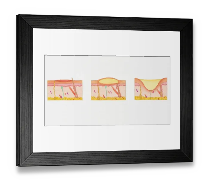 Framed Print : Illustration of blistering second degree burn in epidermis and dermis in three cross sections of human skin Framed Print : Illustration of blistering second degree burn in epidermis and dermis in three cross sections of human skin