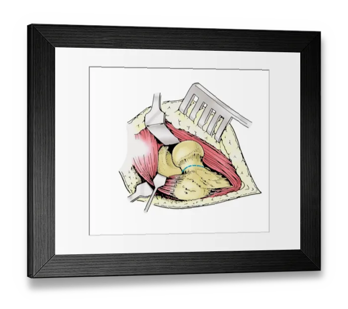 Framed Print : Diagram showing removal of affected head of a femur bone Framed Print : Diagram showing removal of affected head of a femur bone