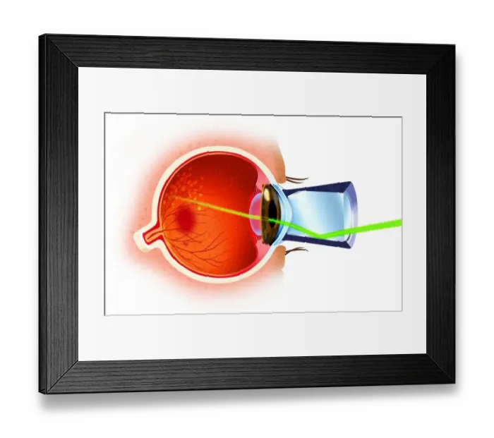 Framed Print : Cross section of eye ball, laser ray entering through pupil, directed at eye nerves Framed Print : Cross section of eye ball, laser ray entering through pupil, directed at eye nerves