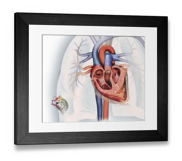 Framed Print : Cross section of human heart and, bottom left, coronary system with aorta, coronary arteries, coronary vein and blood vessels Framed Print : Cross section of human heart and, bottom left, coronary system with aorta, coronary arteries, coronary vein and blood vessels
