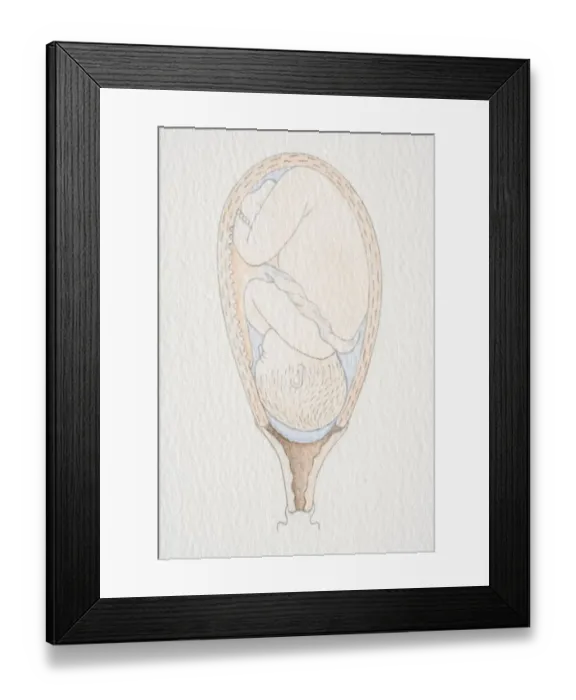 Framed Print : Inverted foetus inside swollen uterus, with amniotic sac still intact and head pushing through the dilated cervix opening