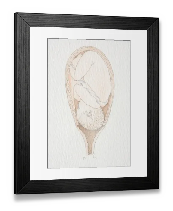 Framed Print : Inverted foetus inside swollen uterus with head pushing through the dilated cervix opening Framed Print : Inverted foetus inside swollen uterus with head pushing through the dilated cervix opening
