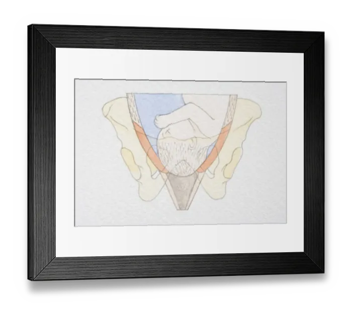Framed Print : Section diagram of swollen uterus with foetus head pushing through the dilated cervix opening Framed Print : Section diagram of swollen uterus with foetus head pushing through the dilated cervix opening