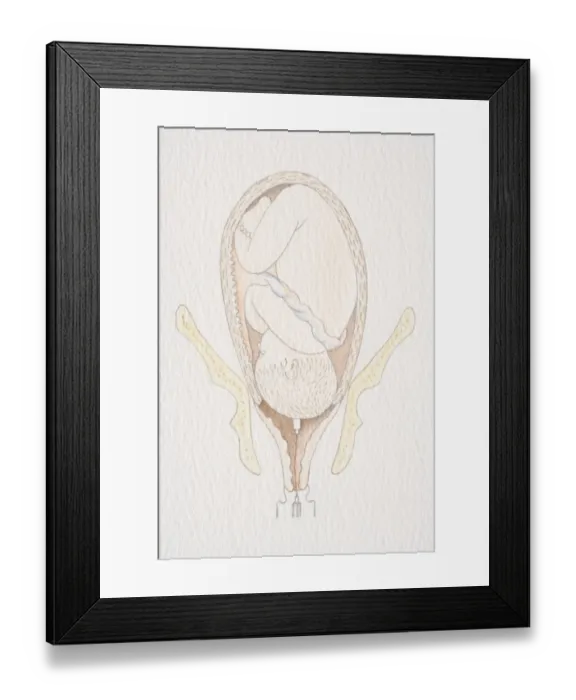 Framed Print : Inverted foetus inside swollen uterus with head pushing through the dilated cervix opening Framed Print : Inverted foetus inside swollen uterus with head pushing through the dilated cervix opening