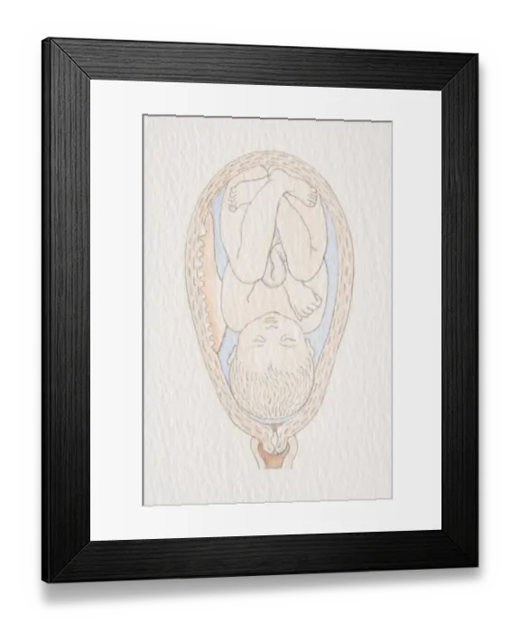 Framed Print : Swollen womb with inverted foetus head pointing to cervix opening Framed Print : Swollen womb with inverted foetus head pointing to cervix opening