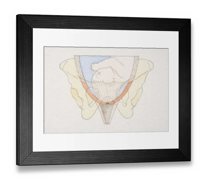 Framed Print : Section diagram of swollen uterus with foetus head pushing down on cervix opening