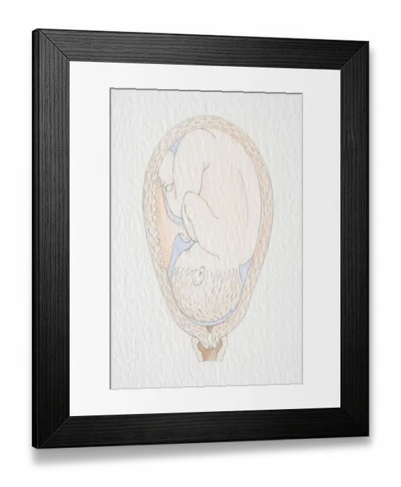 Framed Print : Inverted foetus inside swollen uterus Framed Print : Inverted foetus inside swollen uterus