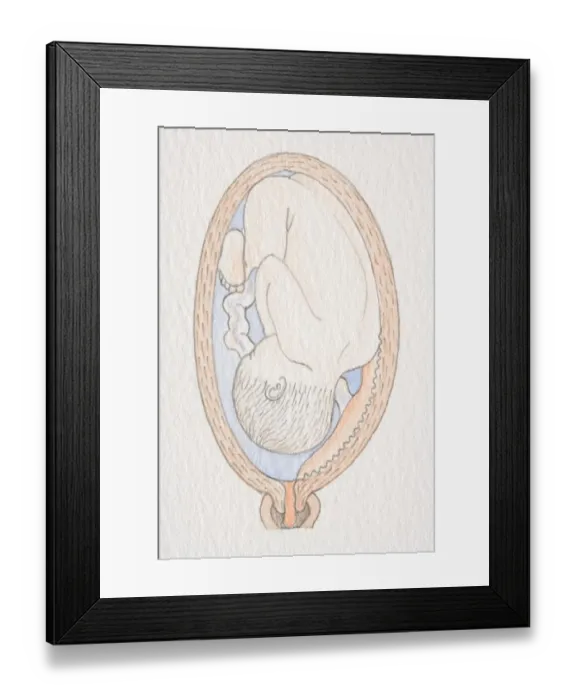 Framed Print : Inverted foetus inside swollen uterus with placenta close to the cervix opening Framed Print : Inverted foetus inside swollen uterus with placenta close to the cervix opening