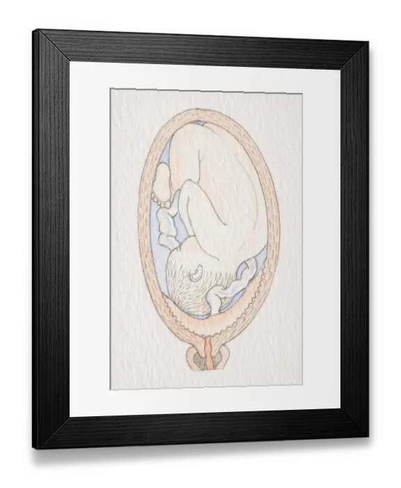 Framed Print : Inverted foetus inside swollen uterus with placenta covering cervix opening