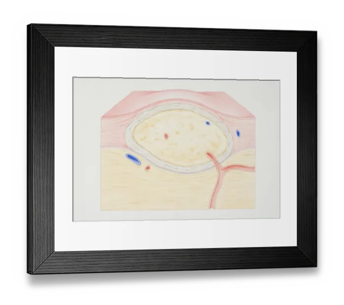 Framed Print : Cross-section diagram of a non-cancerous tumour including a fibrous capsule, tissue layer and blood vessel