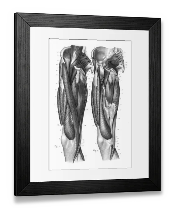Framed Print : Femoral region anatomy engraving 1866 Framed Print : Femoral region anatomy engraving 1866