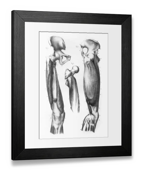 Framed Print : Femoral region anatomy engraving 1866 Framed Print : Femoral region anatomy engraving 1866