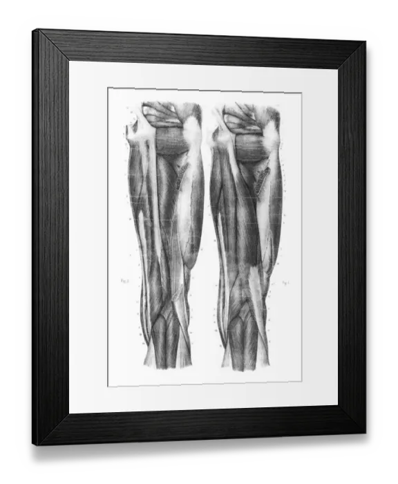 Framed Print : Femoral region anatomy engraving 1866 Framed Print : Femoral region anatomy engraving 1866