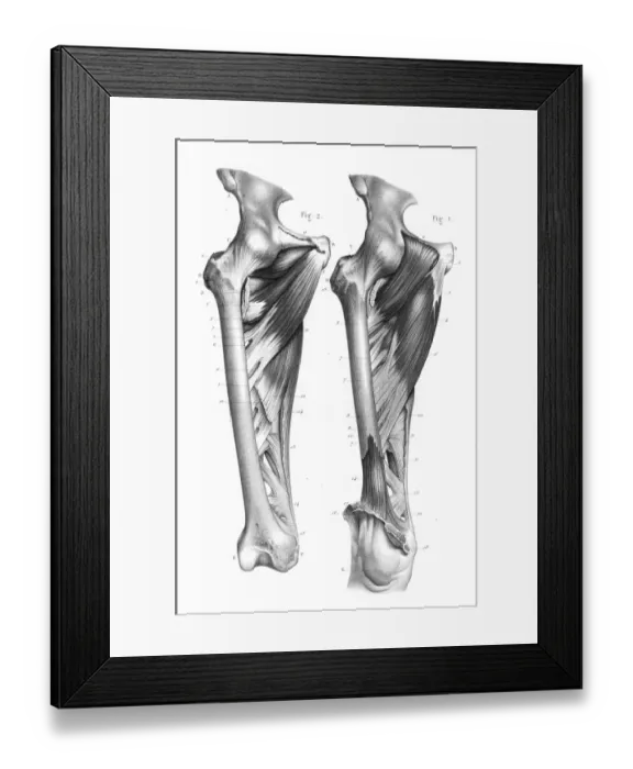 Framed Print : Femoral region anatomy engraving 1866 Framed Print : Femoral region anatomy engraving 1866