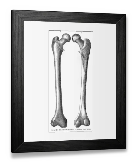 Framed Print : Femur bones anatomy engraving 1857 Framed Print : Femur bones anatomy engraving 1857