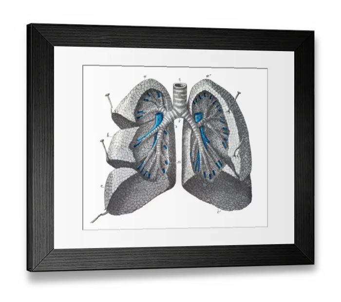 Framed Print : Pulmonary mass engraving 1899 Framed Print : Pulmonary mass engraving 1899