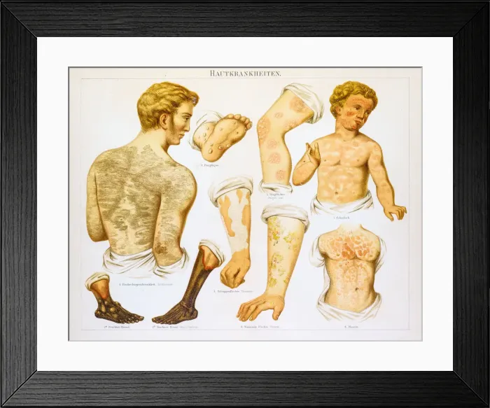 Framed Print : Skin diseases lithography 1895 Framed Print : Skin diseases lithography 1895