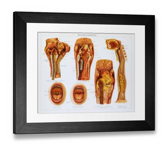 Framed Print : Throat diseases lithography 1895 Framed Print : Throat diseases lithography 1895