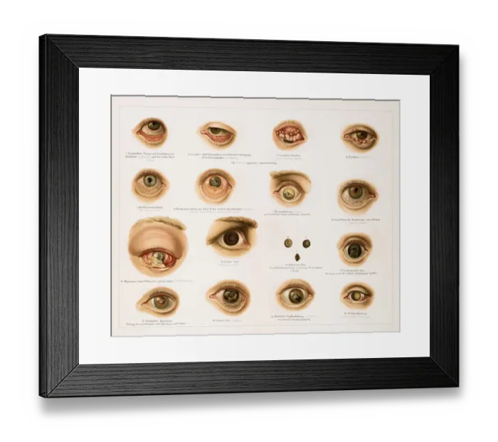Framed Print : Human eye diseases lithograph 1896 Framed Print : Human eye diseases lithograph 1896