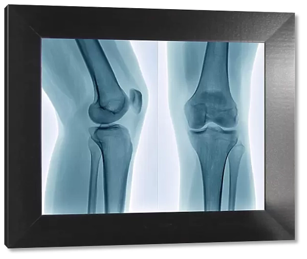 Healthy knee, X-ray