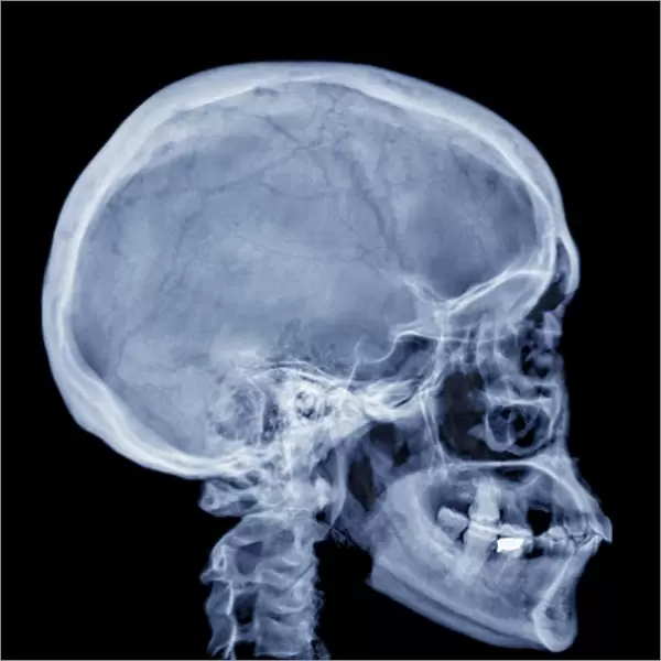 Normal skull, X-ray