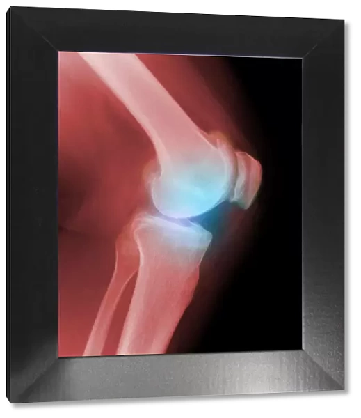 Arthritic knee, X-ray