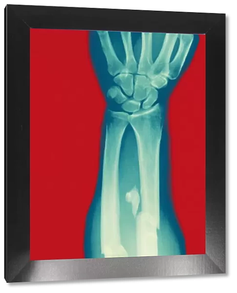 Anatomy, Biology, Broken, Close-Up, Color Image, Colored Background, Forearm, Fracture
