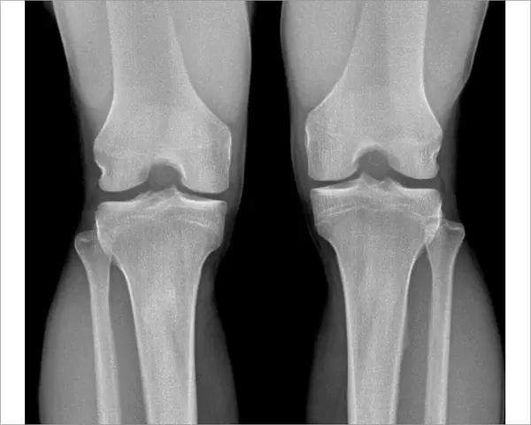 Normal knees, X-ray