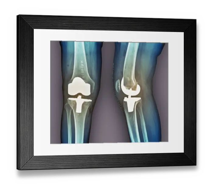 Framed Print : Total knee replacement, X-rays Framed Print : Total knee replacement, X-rays