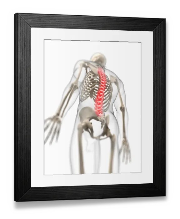 Framed Print : Back pain, conceptual artwork Framed Print : Back pain, conceptual artwork