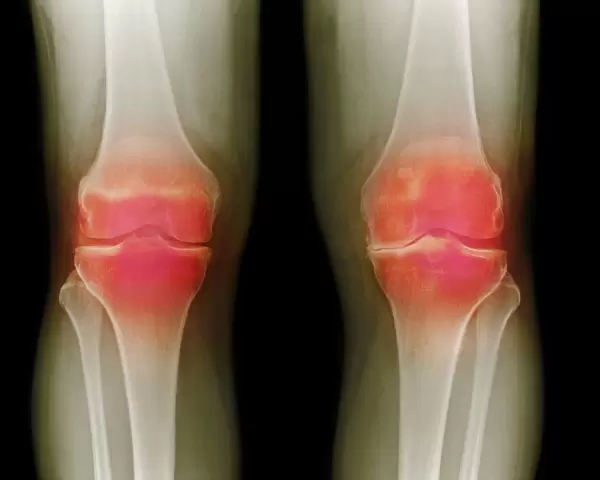 Arthritic knees, X-ray