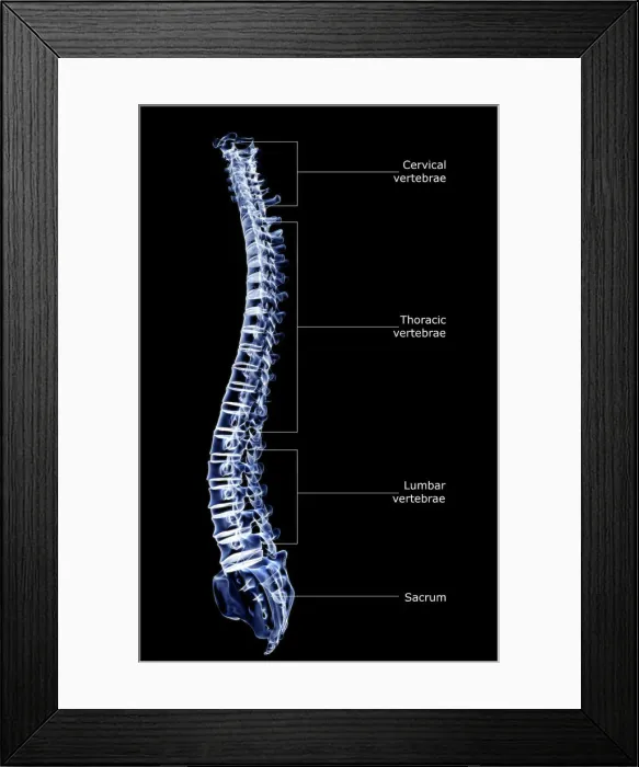 Framed Print : anatomy, back bone, back view, black background, bone, bone structure, bones, cervical vertebrae Framed Print : anatomy, back bone, back view, black background, bone, bone structure, bones, cervical vertebrae