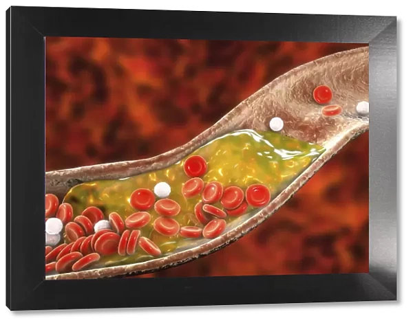Atheromatous plaque in artery, illustration