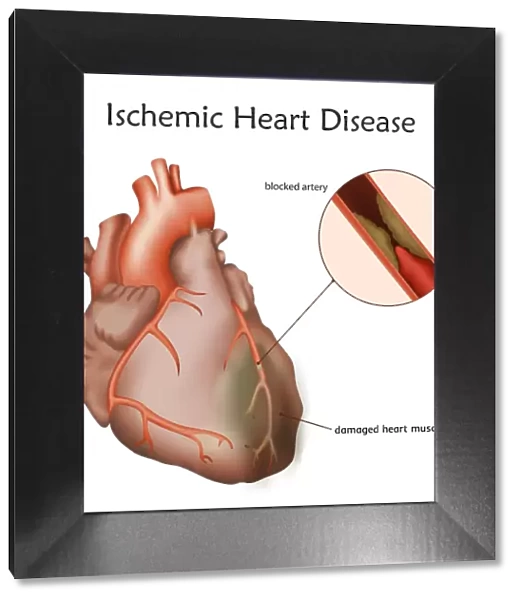 Ischemic heart disease, illustration