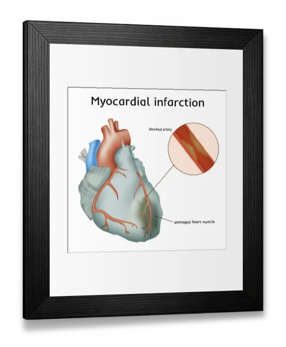 Framed Print : Heart attack, illustration Framed Print : Heart attack, illustration