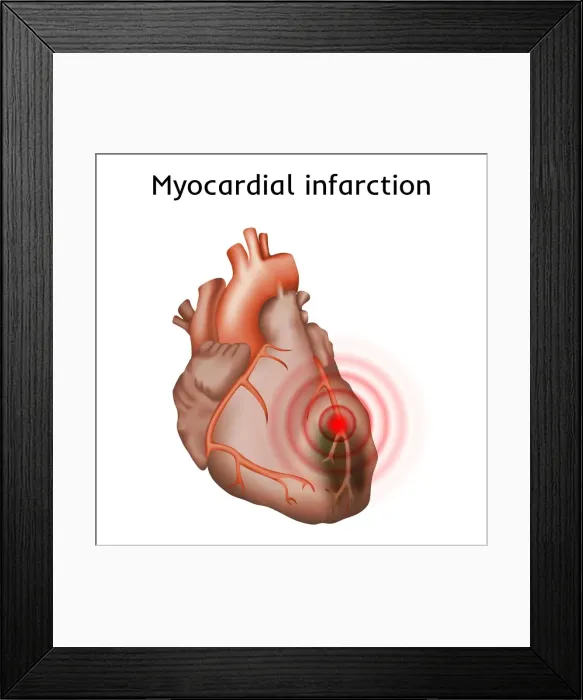 Framed Print : Heart attack, illustration Framed Print : Heart attack, illustration