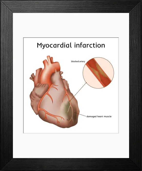 Framed Print : Heart attack, illustration