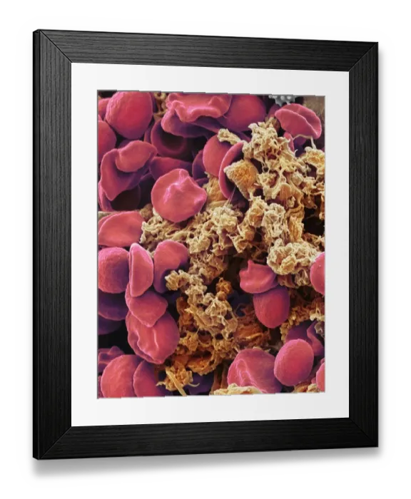 Framed Print : Red blood cells and platelets, SEM Framed Print : Red blood cells and platelets, SEM