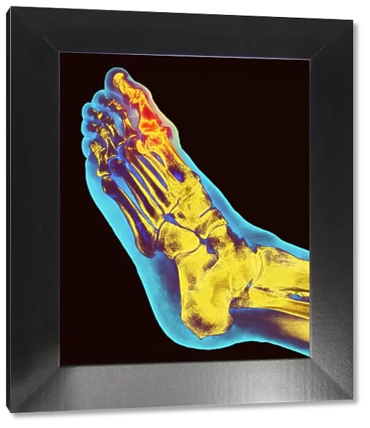 Degenerative foot deformation, X-ray