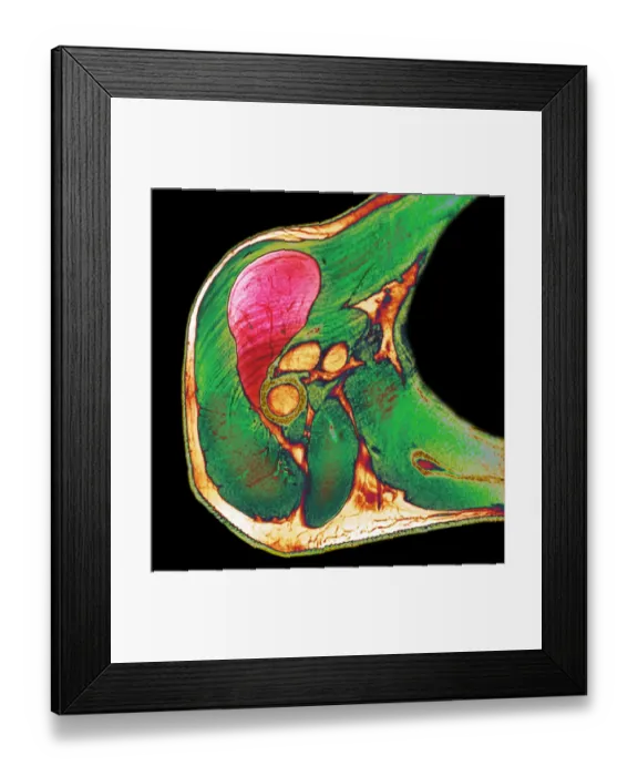 Framed Print : Lipoma of the shoulder, X-ray Framed Print : Lipoma of the shoulder, X-ray