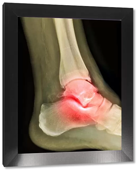 Arthritic ankle, X-ray