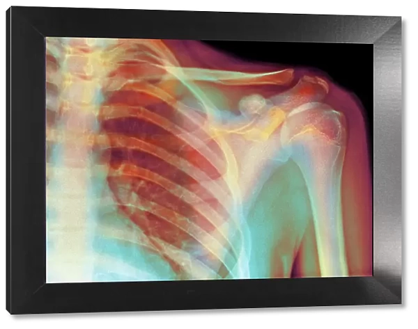 Normal shoulder, X-ray