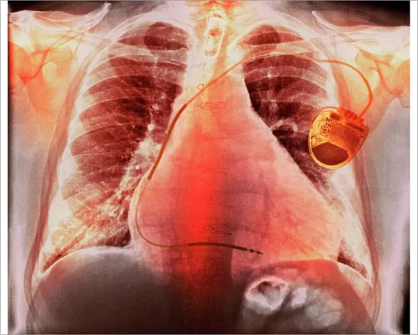 Pacemaker in heart disease, X-ray