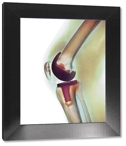 Knee replacement, X-ray