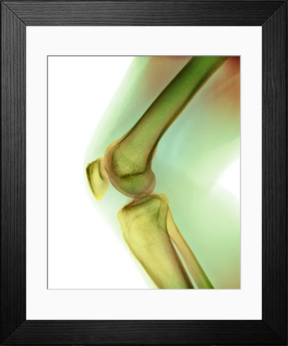 Framed Print : Normal knee, X-ray Framed Print : Normal knee, X-ray